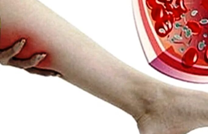 Varizes veias na perna