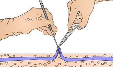 Operação para varizes veias