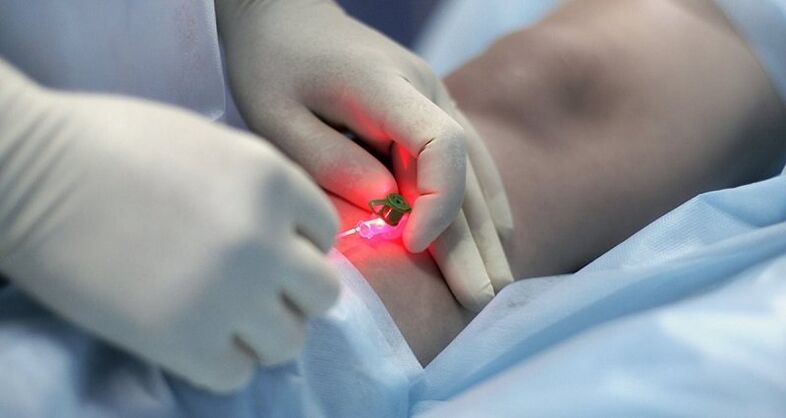 Tratamento cirúrgico de varizes