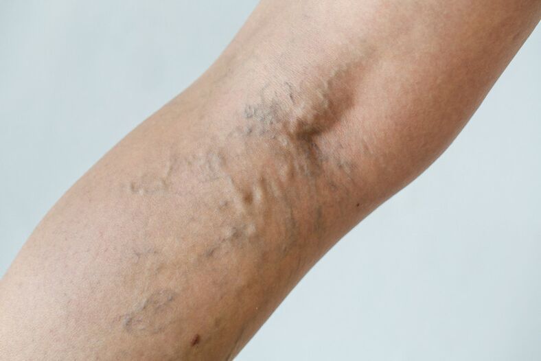 Estágio C2 – varizes poplíteas (perfurante de Thierry) e veias reticulares