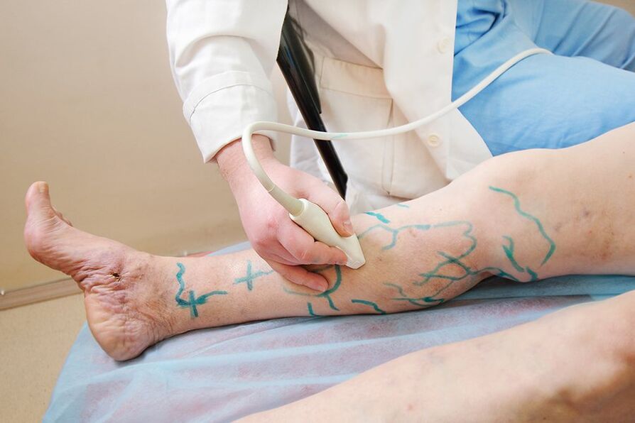 Preparação para miniflebectomia - marcação das perfurantes da perna, realização de ultrassonografia